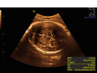 ACC axial non-visualized corpus callosum